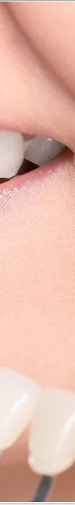 광화문치과 라미네이트 치료 전 고민해야 할 것 관련 이미지 31