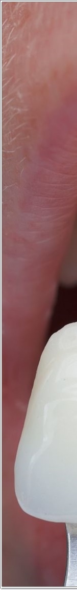 명동치과 치아 라미네이트의 모든 것: 앞니부터 어금니까지 관련 이미지 7