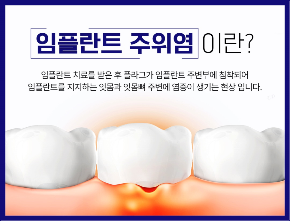 종로임플란트 건강한 치아를 위한 현명한 선택 관련 이미지 7
