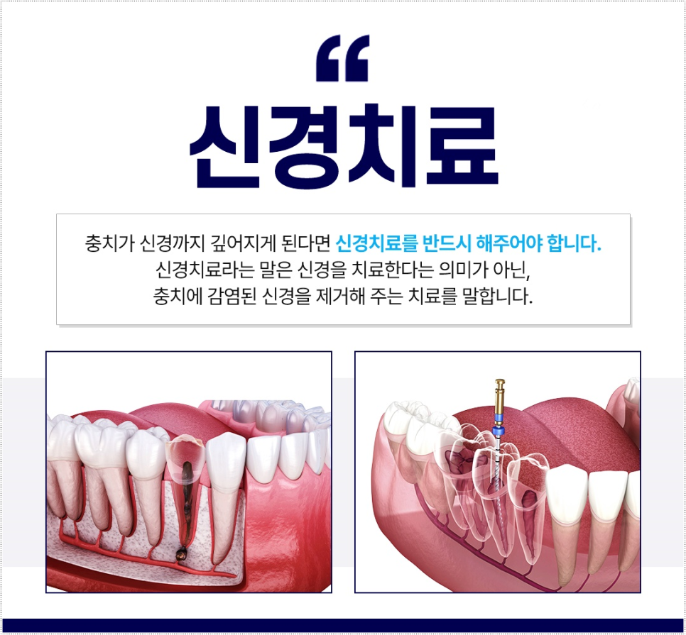명동치과에서 들은 충치부터 신경치료까지 핵심정리 관련 이미지 4