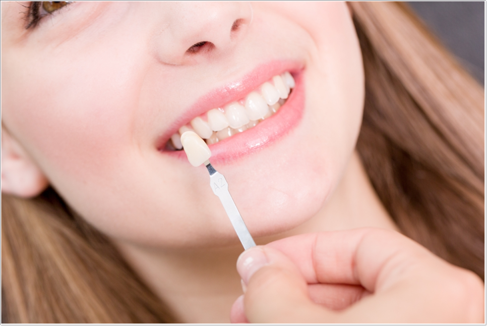 종로치과 치아미백 효과는 얼마나 지속될까? 관련 이미지 8