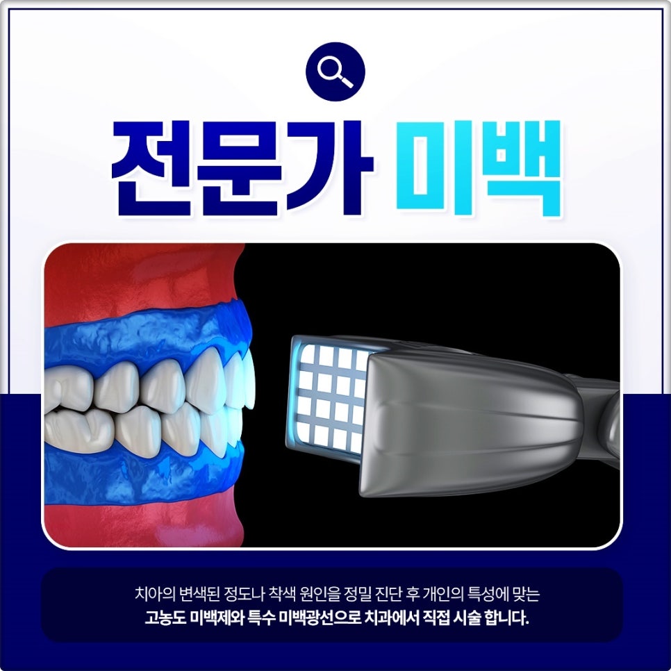 종각치과 누런치아 어떻게 해결하면 좋을까요? 전문가 치아미백 가이드 관련 이미지 6