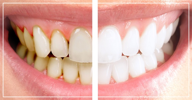 치아미백에 관한 모든 것! 관련 이미지 2