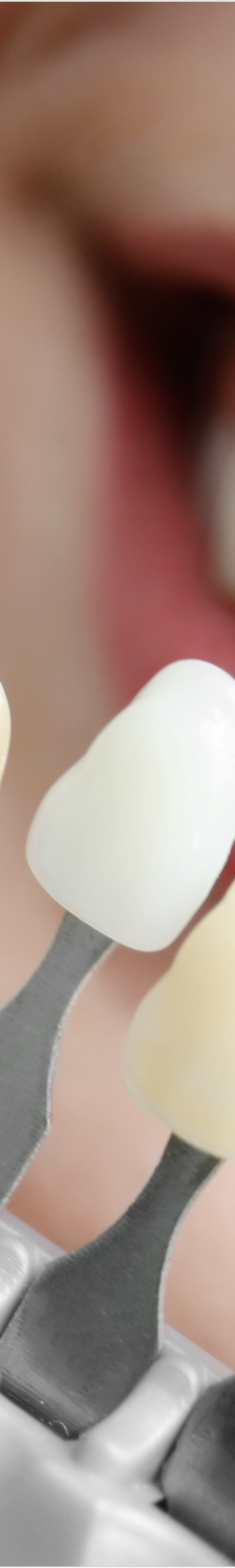 을지로입구역치과에서 알려드리는 치아미백과 라미네이트의 모든 것 관련 이미지 20