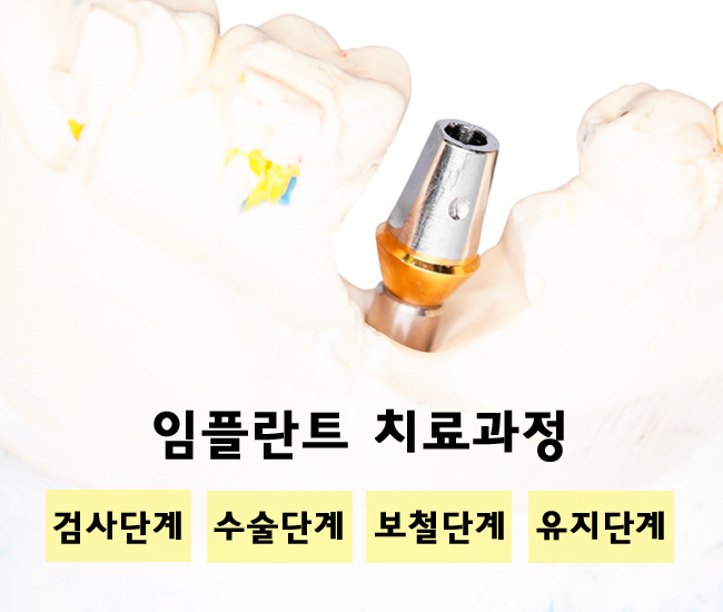 종각임플란트 안전하게! 관련 이미지 4
