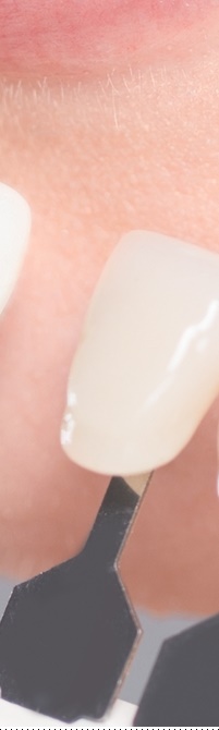 종로치과 라미네이트 주변 치아를 확인하여 자연스럽게 관련 이미지 23