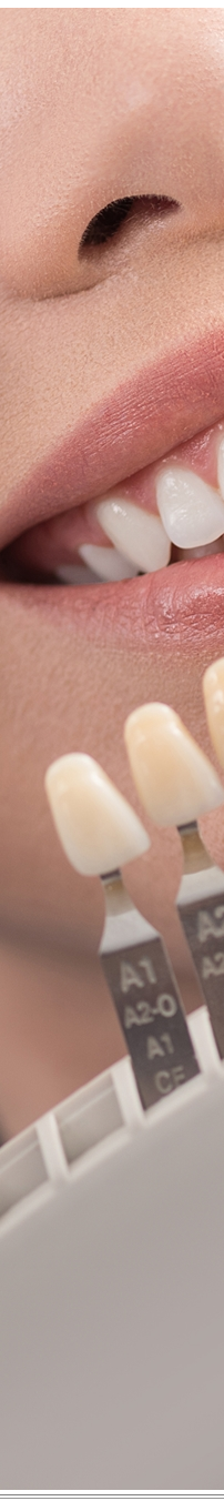 광화문역치과 치아미백과 라미네이트 나에게 필요한 건? 관련 이미지 17