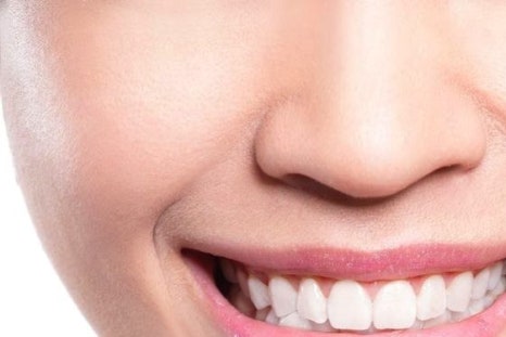 명동치과에서 알아보는 치아미백의 모든 것 관련 이미지 19