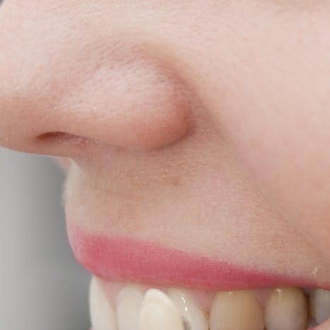 을지로입구치과 라미네이트 치료, 어디까지 알고 있나요? 관련 이미지 10