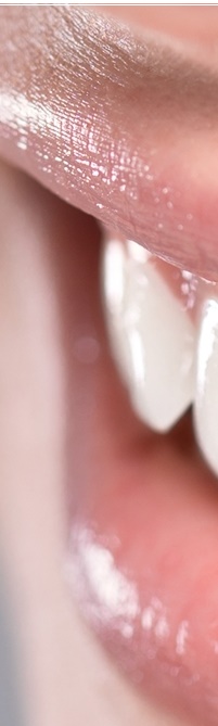 종로치과 라미네이트 주변 치아를 확인하여 자연스럽게 관련 이미지 11