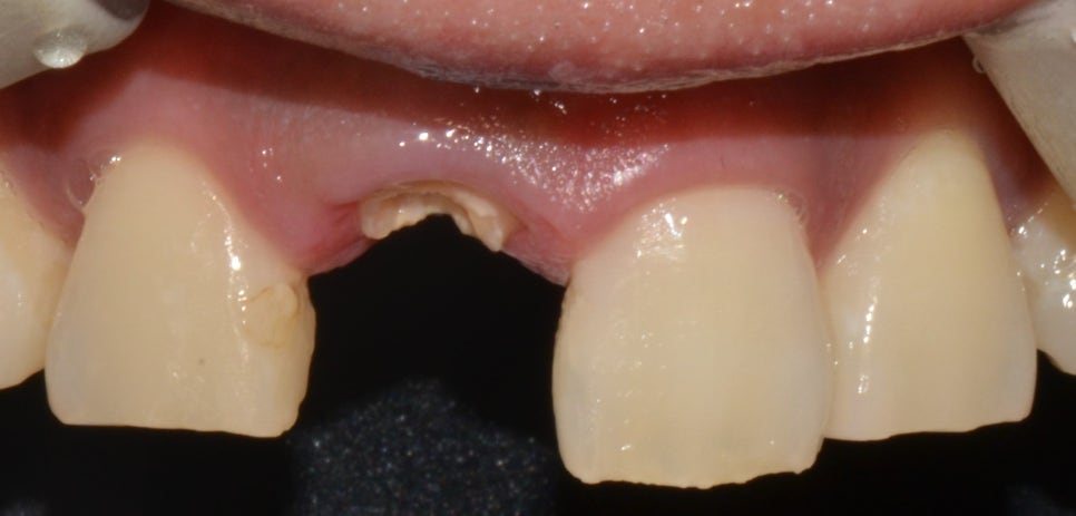 종로구치과 교통사고 나서 병 같은 게 부딪혀 앞니가 깨졌어요. 관련 이미지 3