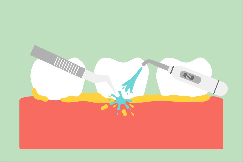 명동치과에서 알려드리는 치아미백, 전문가미백 차이점 관련 이미지 6