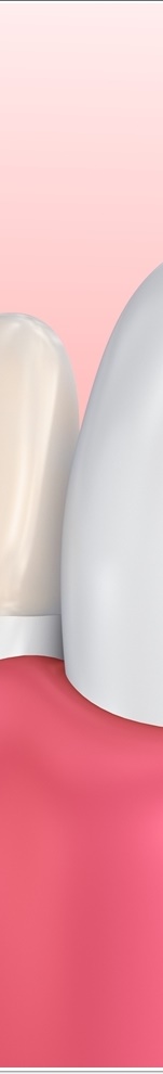 광화문치과 라미네이트 치료 전 고민해야 할 것 관련 이미지 18