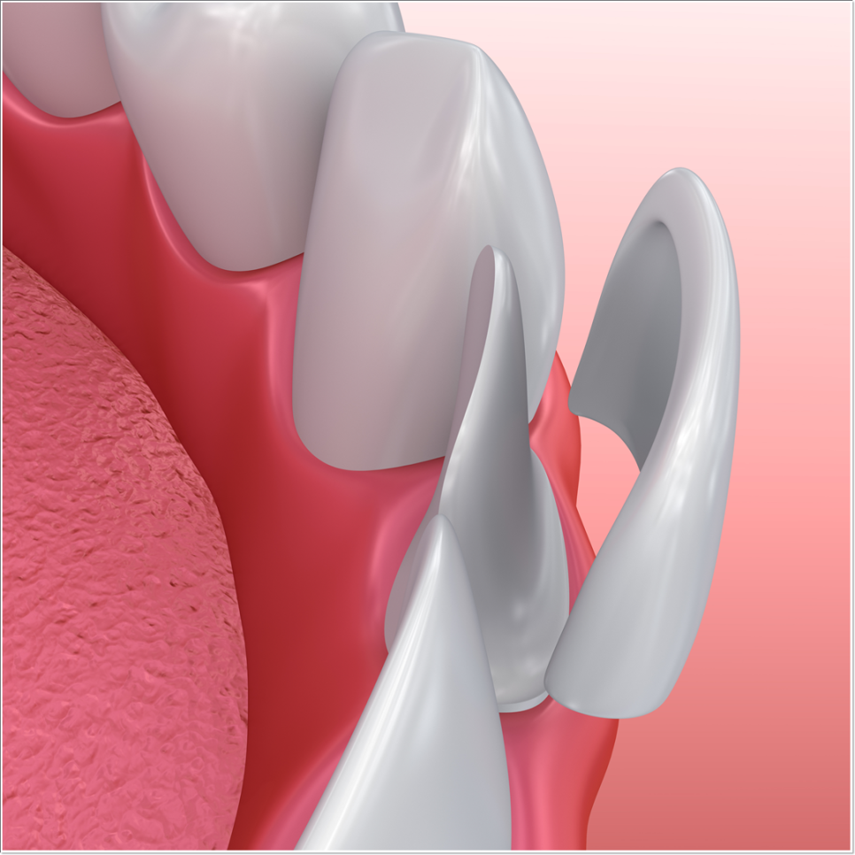 치아 변색 고민 끝, 을지로치과에서 듣는 라미네이트 사례 관련 이미지 17