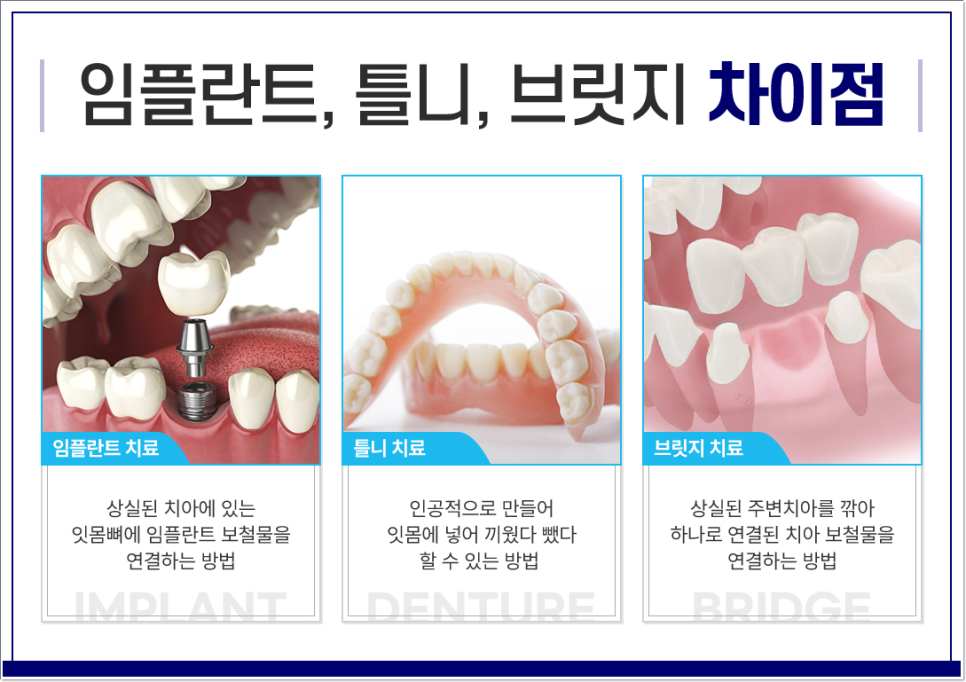 광화문역치과 치아 상실에 임플란트가 필요한 이유 관련 이미지 3