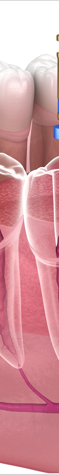 종각역치과 자연치아를 살리기 위한 대책, 신경치료 관련 이미지 12