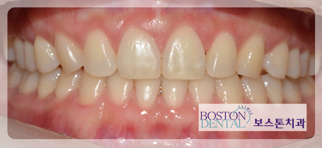 종각역치아교정 확실한 효과~! 관련 이미지 6