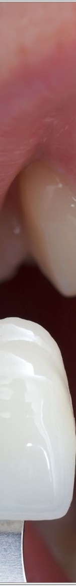 명동치과 치아 라미네이트의 모든 것: 앞니부터 어금니까지 관련 이미지 8