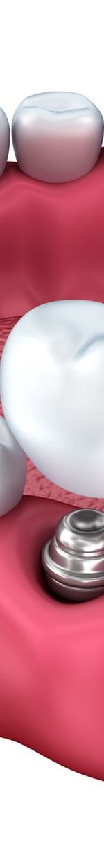 종각역치과 충치를 방치하면 신경치료를 해야 한다. 관련 이미지 11