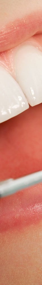 광화문치과 치아미백 그 후 관련 이미지 13