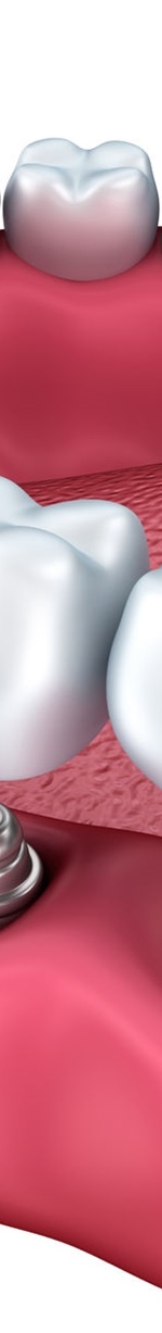 종각역치과 충치를 방치하면 신경치료를 해야 한다. 관련 이미지 12