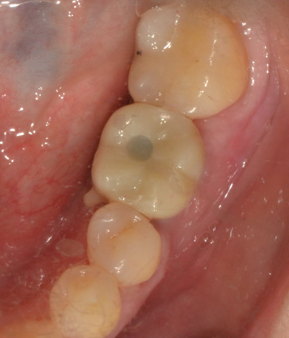 종로구치과 발치한지 2~3년이 지났어요 관련 이미지 6