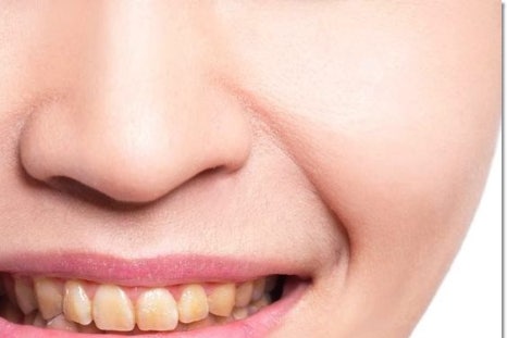 명동치과에서 알아보는 치아미백의 모든 것 관련 이미지 21