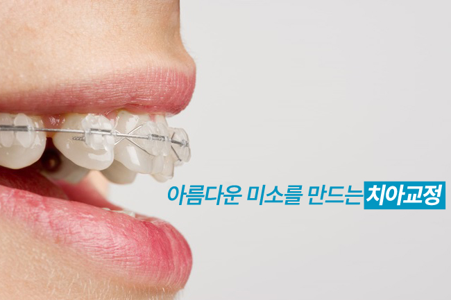 종로치아교정 안심하고 시작! 관련 이미지 2