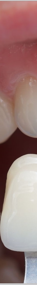 명동치과 치아 라미네이트의 모든 것: 앞니부터 어금니까지 관련 이미지 9