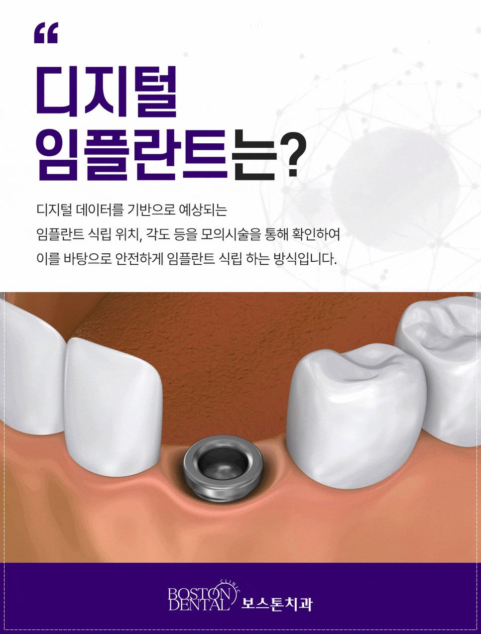 광화문역치과 상실한 치아 바로 해결을 해줘야 하는 이유 관련 이미지 4