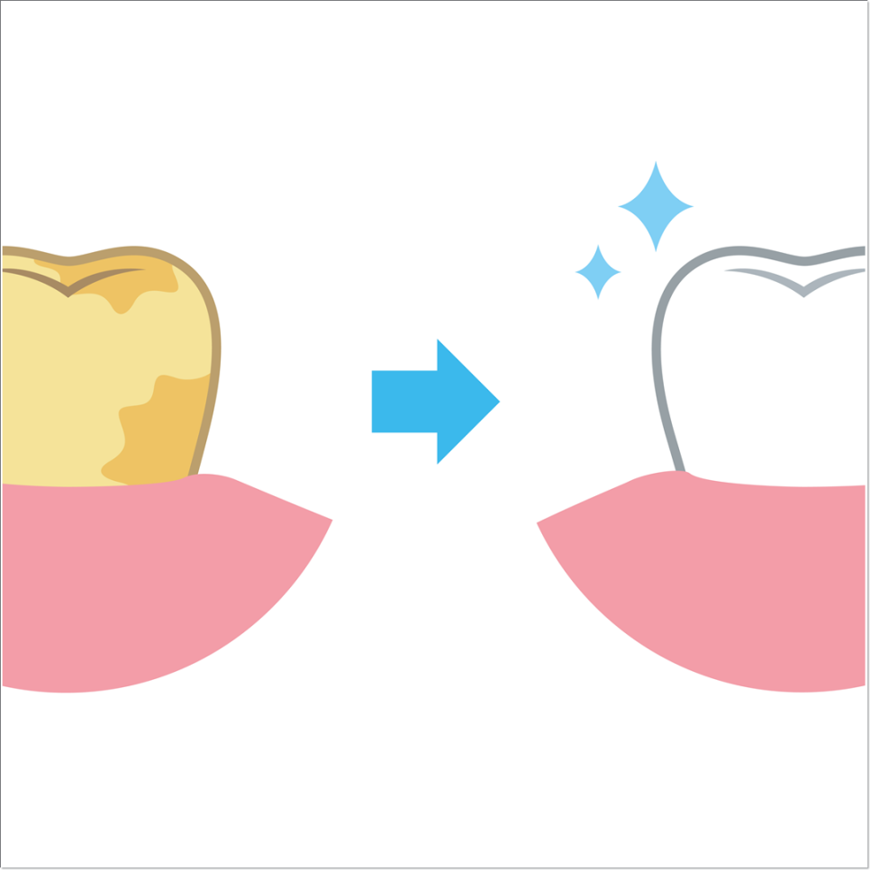 치아 변색 고민 끝, 을지로치과에서 듣는 라미네이트 사례 관련 이미지 9