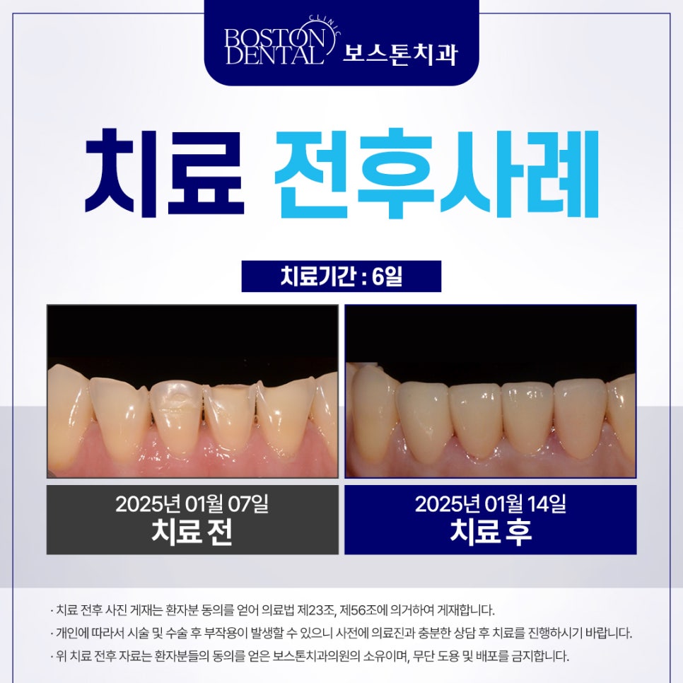 [종로치과추천] 치아가 마모되어 보기 싫어요ㅠㅠ 관련 이미지 4