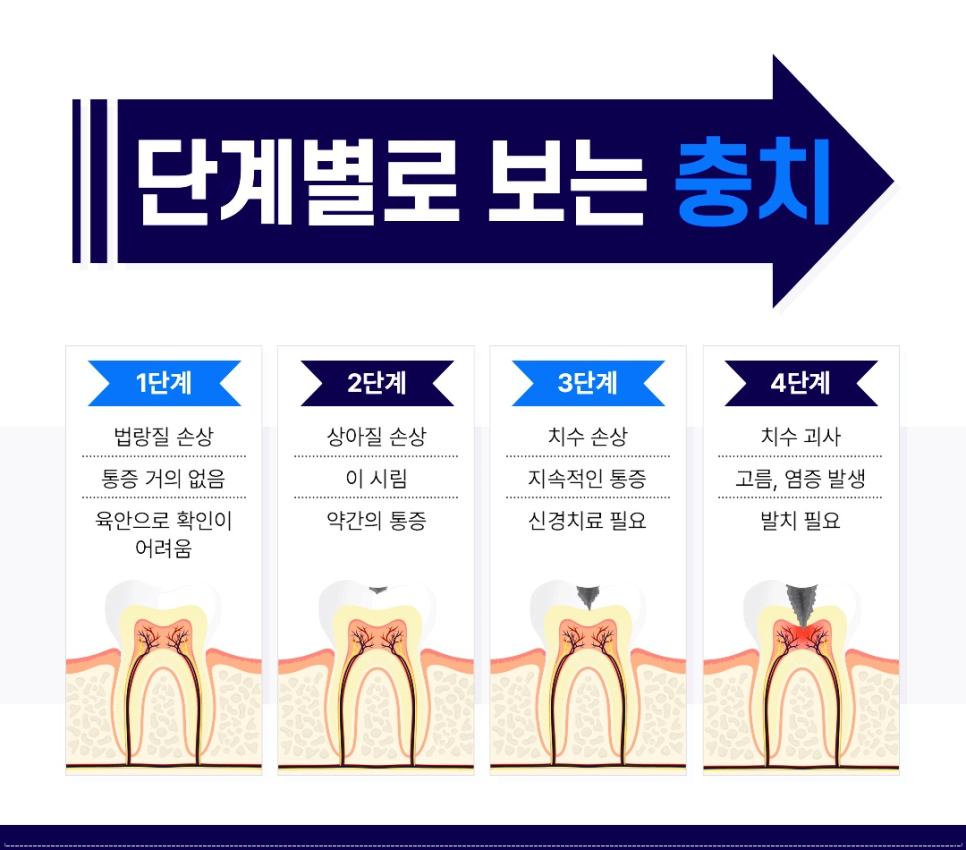 A Guide to Cavity Treatment from Jonggak Station Dental Clinic image 2