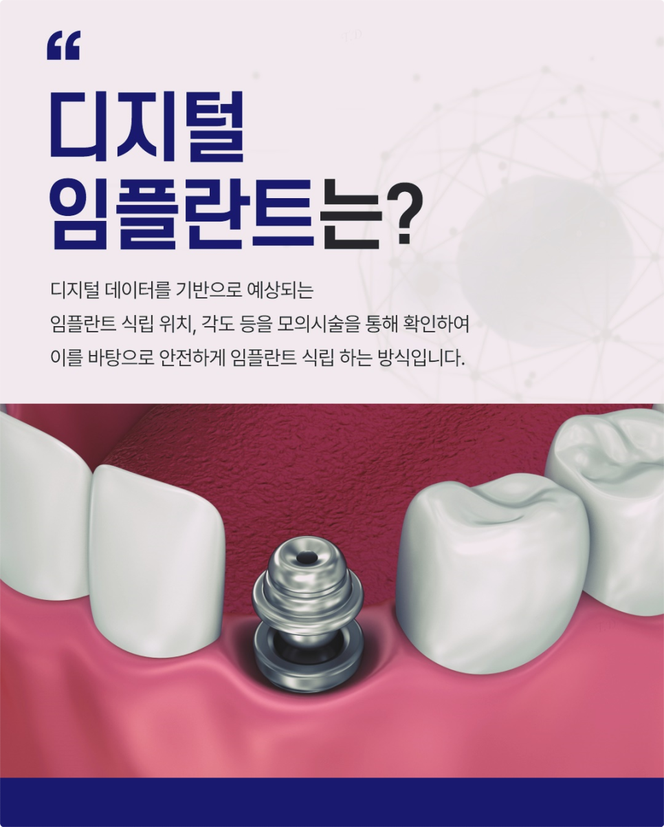 종로치과 치아가 빠져있는 상태여서 임플란트 고민하고 계신가요? 관련 이미지 7