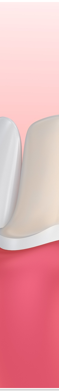 광화문역치과 치아미백과 라미네이트 나에게 필요한 건? 관련 이미지 9