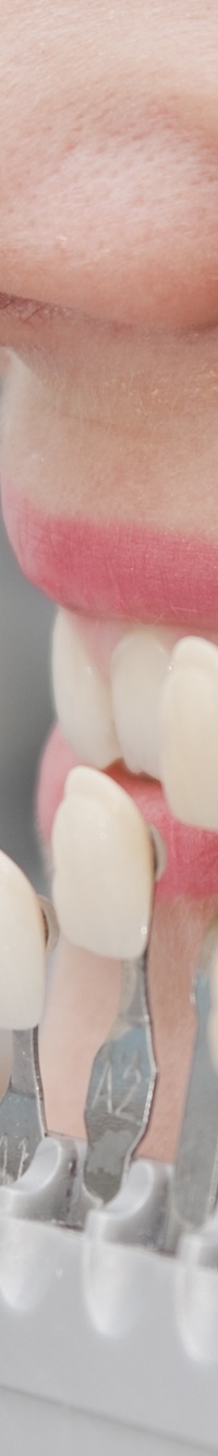 종로치과 자연스러운 라미네이트 색, 얼마나 하얘야 예쁠까? 관련 이미지 11