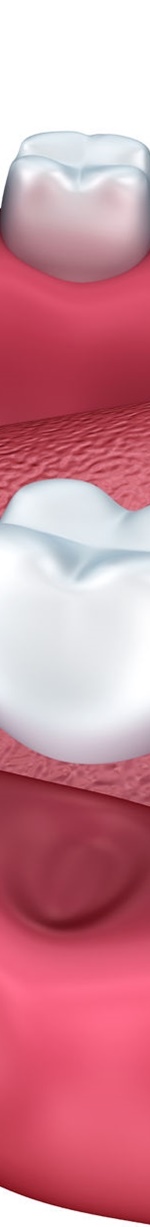 종각역치과 충치를 방치하면 신경치료를 해야 한다. 관련 이미지 13