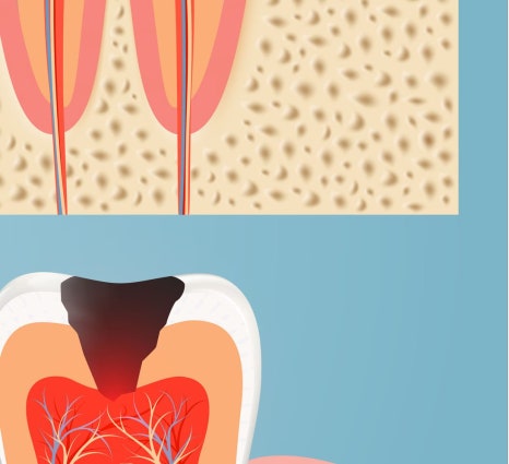 종로치과 충치가 생겼을 때 어떻게 치료 받아야 하나요? 관련 이미지 15