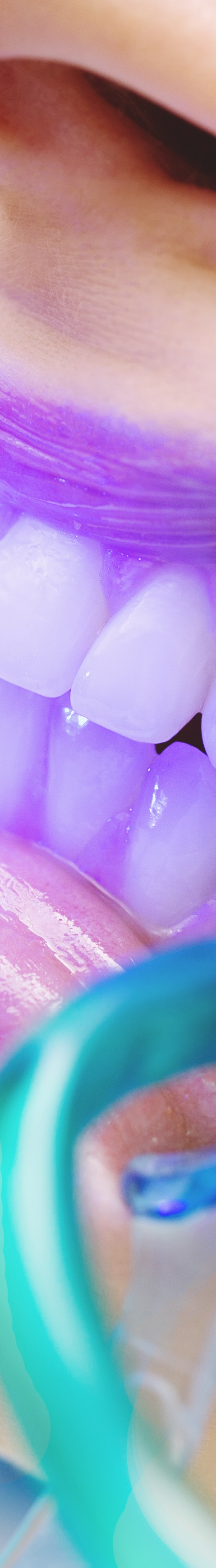 광화문역치과 치아미백과 라미네이트의 차이는? 관련 이미지 19