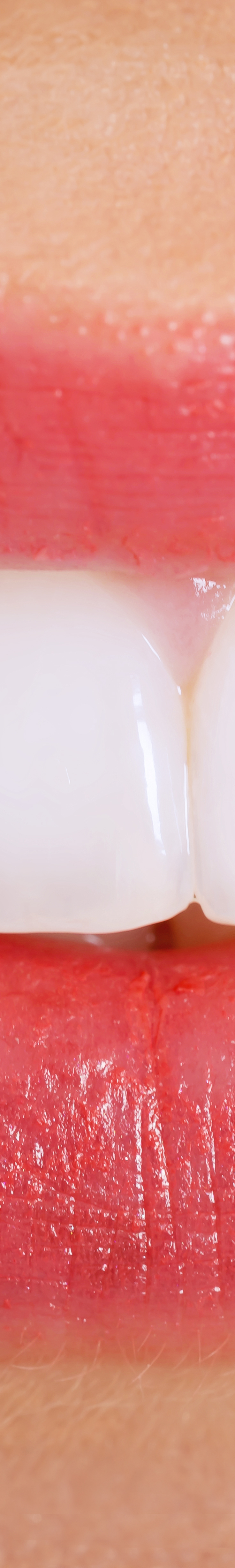 명동치과 전문가 치아 미백 치료 받고 오래 유지할 수 있는 방법 관련 이미지 17