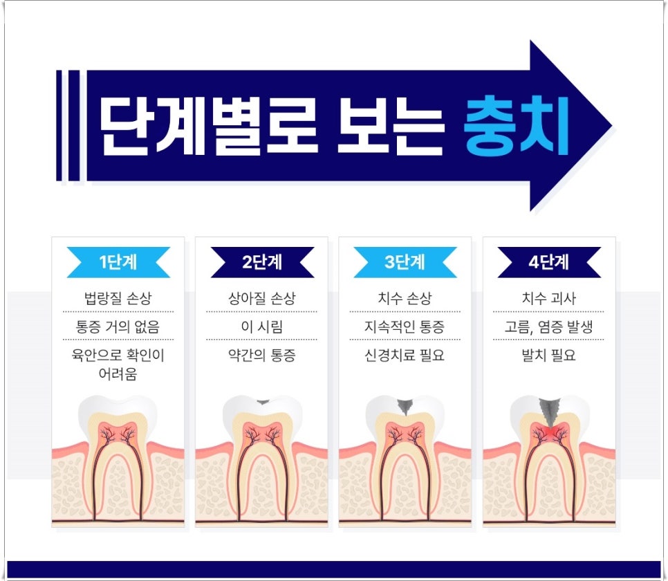 명동치과 치아가 욱씬욱씬 아프신가요? 관련 이미지 4