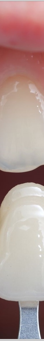 명동치과 치아 라미네이트의 모든 것: 앞니부터 어금니까지 관련 이미지 11