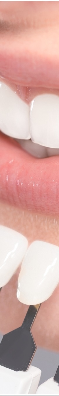 명동치과 치아 라미네이트의 모든 것: 앞니부터 어금니까지 관련 이미지 22