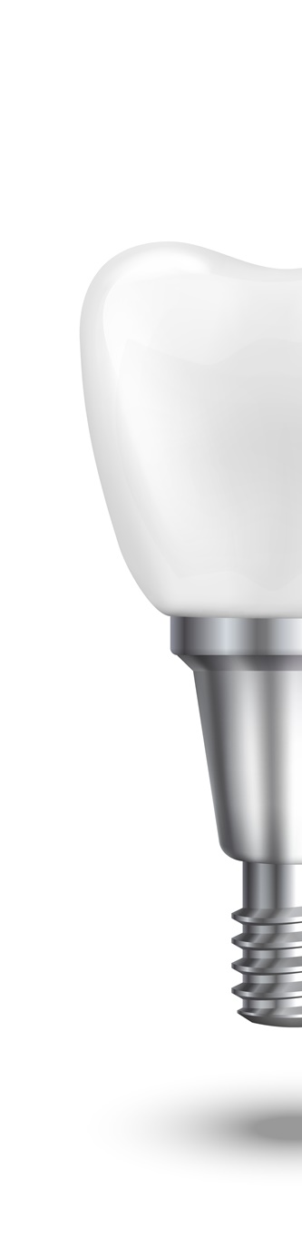 종로치과 임플란트 재식립이 필요하다면? 관련 이미지 7