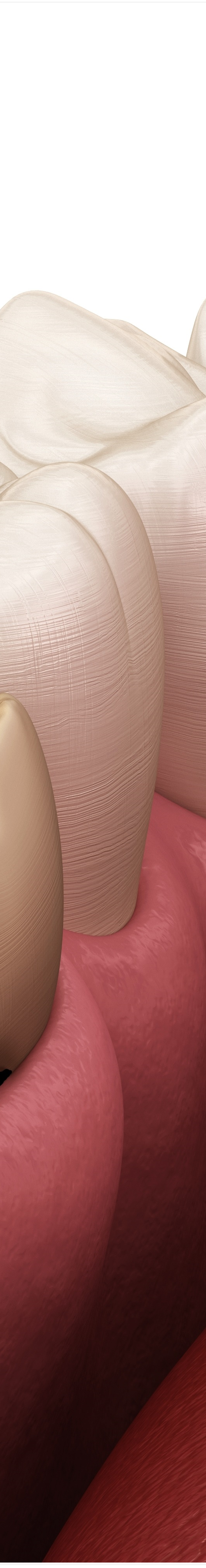 명동치과 치아가 욱씬욱씬 아프신가요? 관련 이미지 36