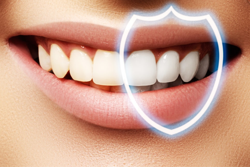 종로3가치과에서 알려드리는 무삭제 라미네이트 완벽 가이드 관련 이미지 3