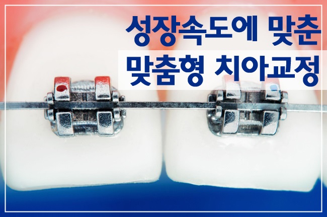 치아교정을 시작하기 좋은 나이는? 관련 이미지 1