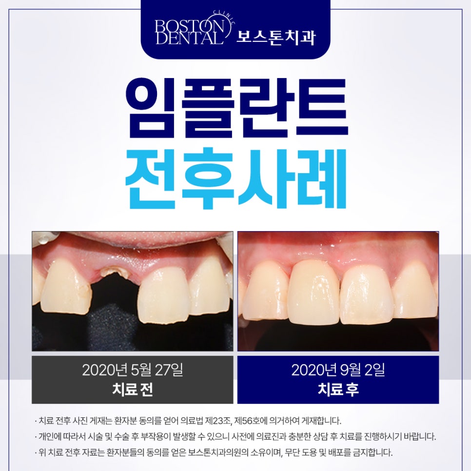 종로구치과 교통사고 나서 병 같은 게 부딪혀 앞니가 깨졌어요. 관련 이미지 2