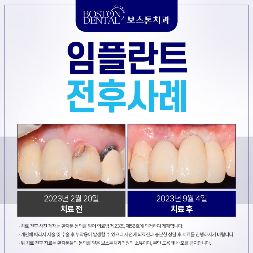 을지로입구역치과 앞니가 흔들리고 아파요 관련 이미지 2