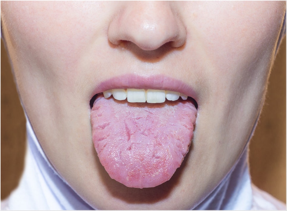 혀가 하얗게 변했다면? 원인과 치료 방법 관련 이미지 2